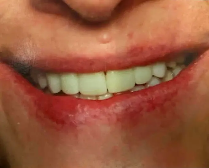 After smile makeover